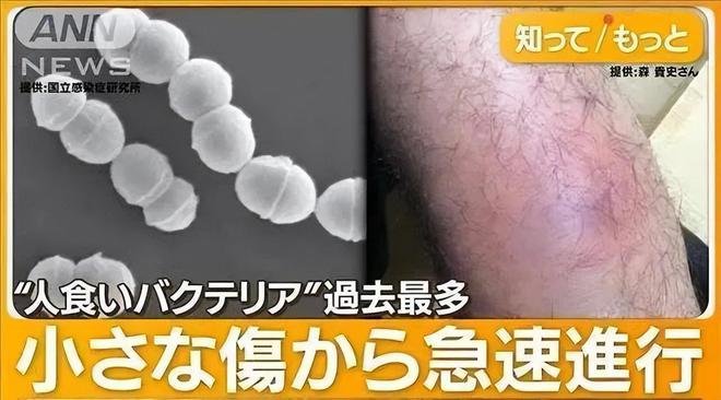 飞沫传播引发恐慌:罕见“食人细菌”在日本蔓延,患者截肢保命