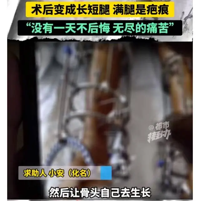 29岁小伙花十几万元断骨增高却落下终身伤残:满腿疤痕,悔恨不已